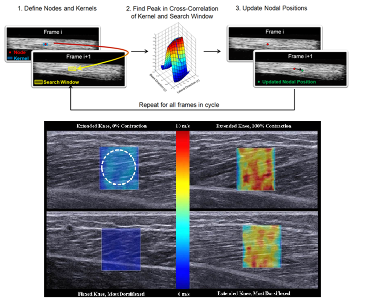 Ultrasound Elastography